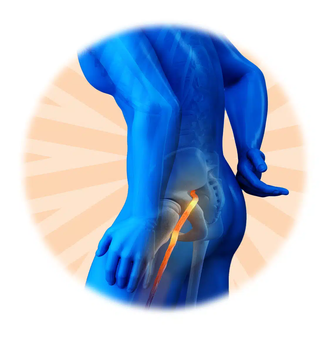 Ischias Schmerz Illustration